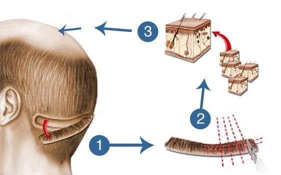 Cấy tóc và một số rủi ro có thể gặp phải Bảng giá cấy tóc Truehair