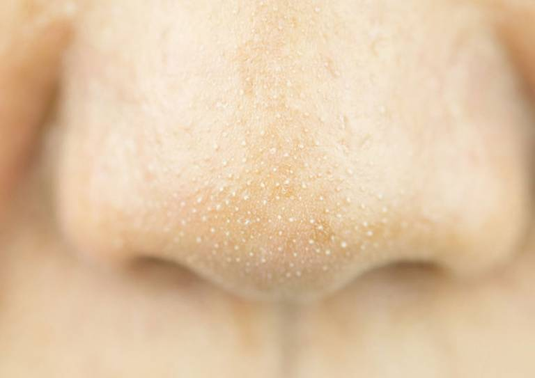 Mụn cám là gì? Có nên lột mụn cám tại nhà không?