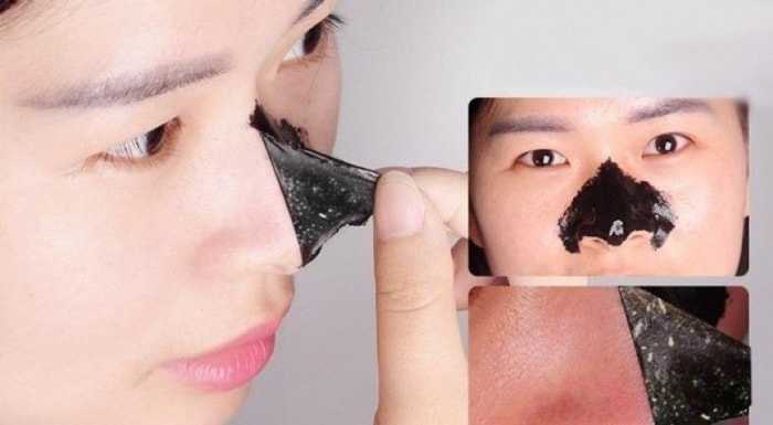 Mụn cám là gì? Có nên lột mụn cám tại nhà không?