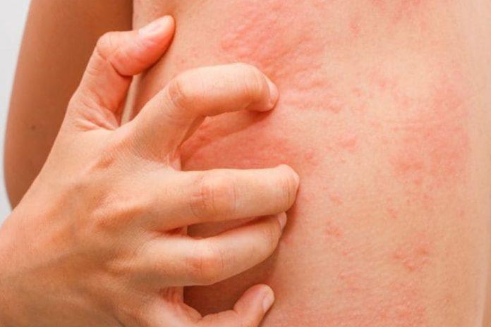 Làm gì khi da bị dị ứng da? Bạn có biết làm gì khi bị dị ứng da