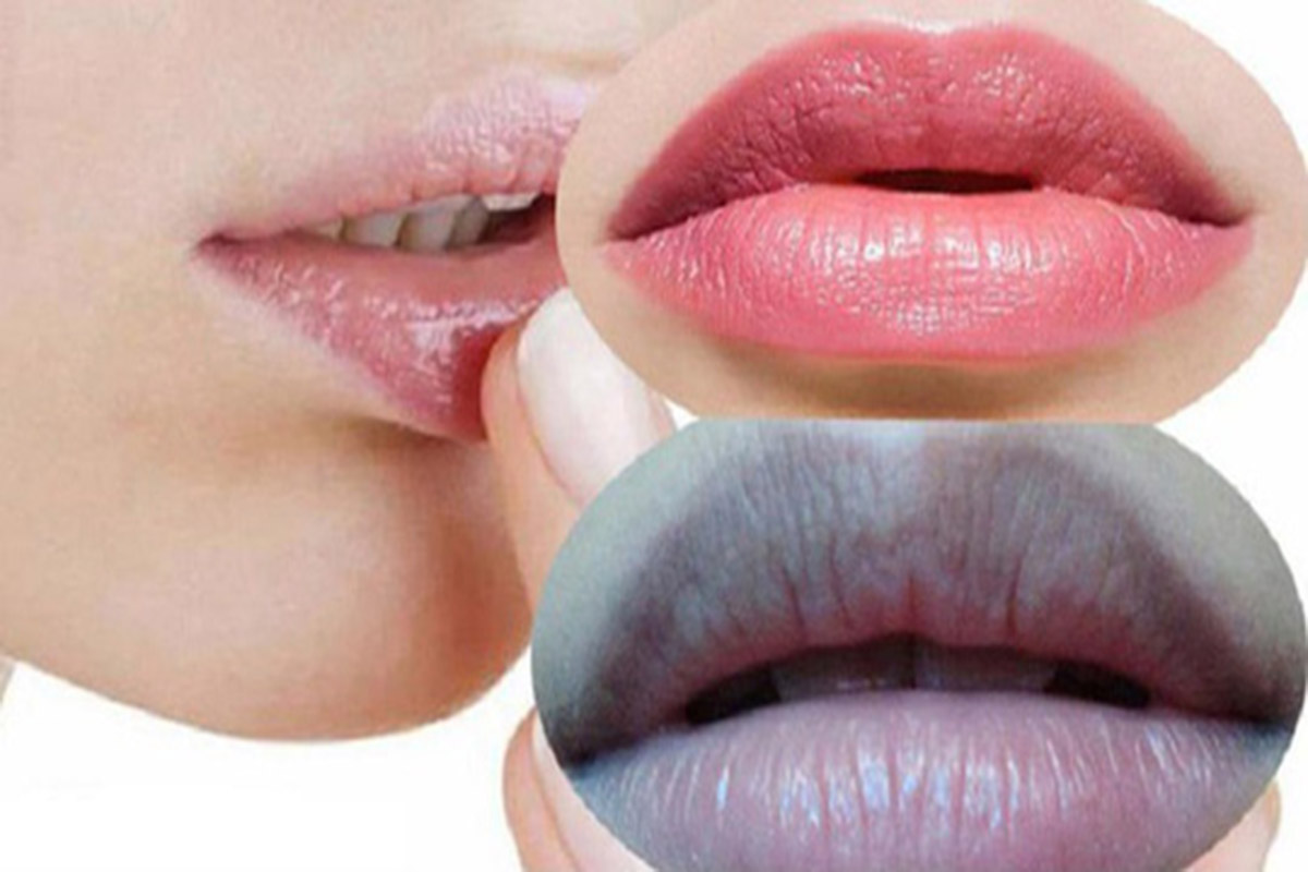 7 cách trị môi hết thâm an toàn, hiệu quả và nhanh chóng