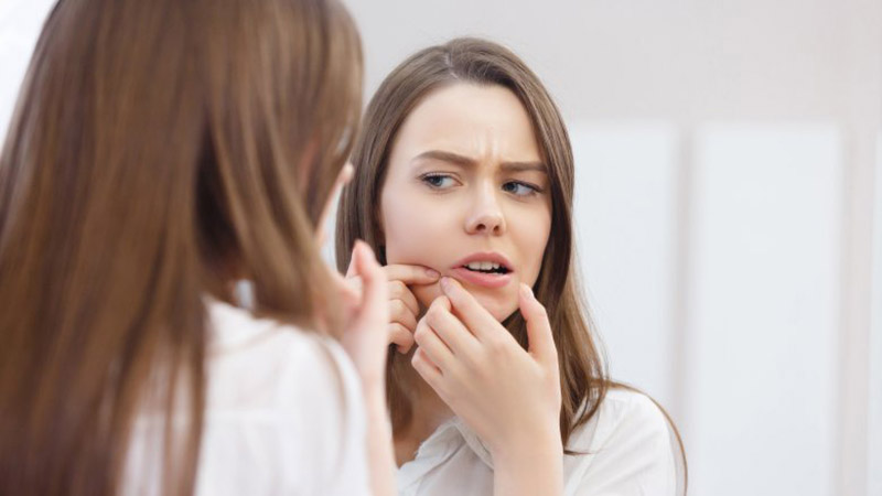 Bị mụn không nên làm gì? Cần tránh ngay để giảm mụn