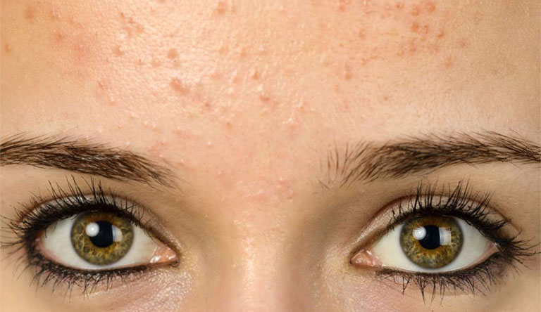 Kem trị mụn loại nào tốt nhất? Bạn đã biết chưa? Kem trị mụn loại nào tốt nhất? Bạn đã biết chưa?