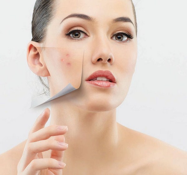 Kem trị mụn loại nào tốt nhất? Bạn đã biết chưa?