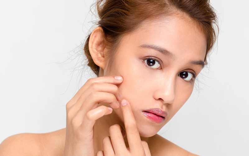 Top kem trị mụn ẩn tốt nhất hiện nay bạn đã biết chưa?