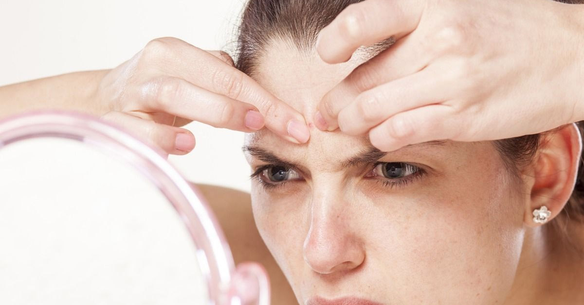 Top kem trị mụn ẩn tốt nhất hiện nay bạn đã biết chưa?