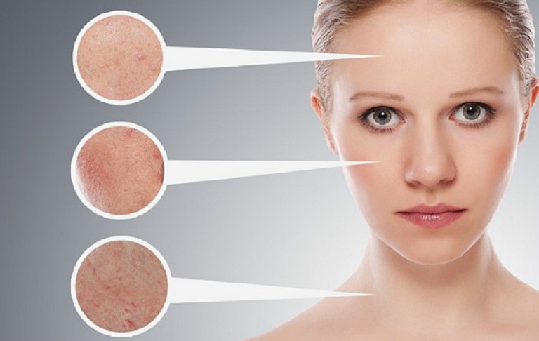 Top kem trị mụn ẩn tốt nhất hiện nay bạn đã biết chưa?