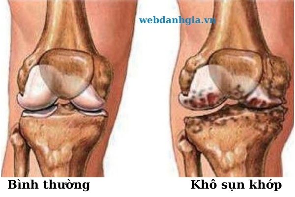 Tinh bột nghệ giúp điều trị viêm khớp 30+ Loi Ich Tu Tinh Bot Nghe Cach Su Dung Va Nhung Sai Lam Can Tranh (5)